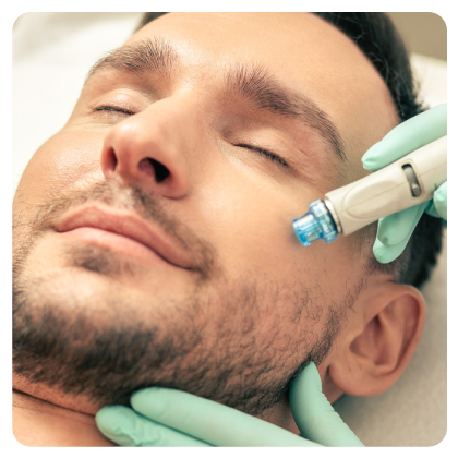 Microneedling PDRN de Salmón