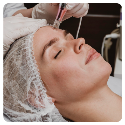Microneedling Exosomas